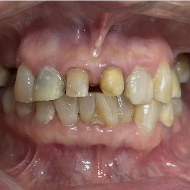 Antes: coronas de zirconia anteriores en NK Art Estudio Dental Querétaro