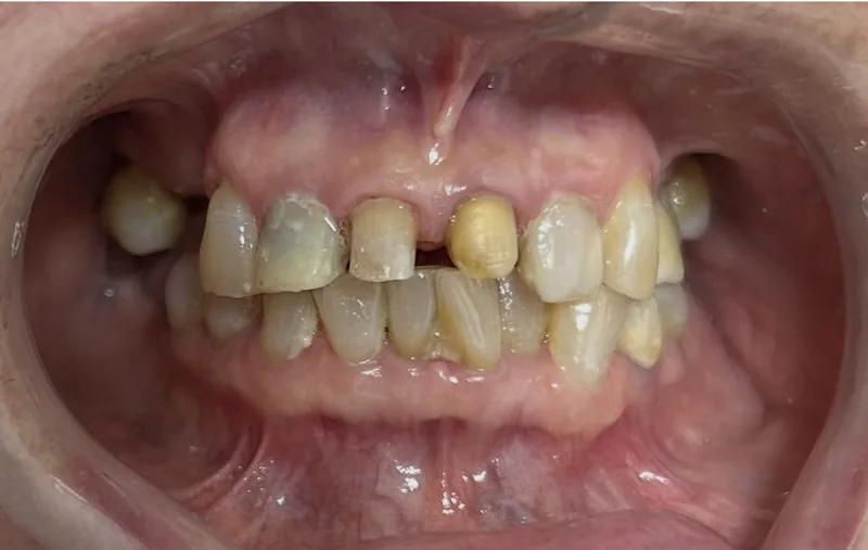 Antes del tratamiento de coronas de zirconia anteriores