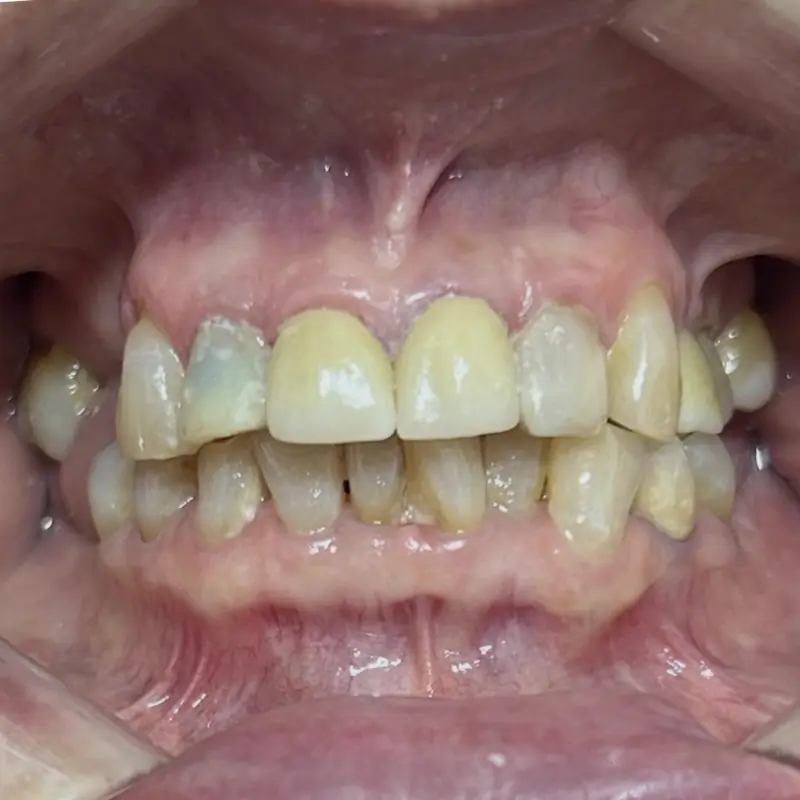 Después: coronas de zirconia anteriores en NK Art Estudio Dental Querétaro