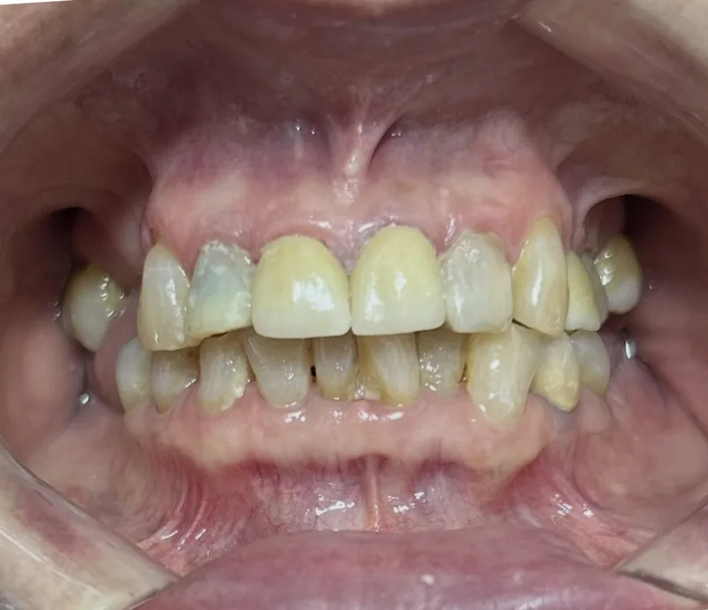 Después de las coronas de zirconia anteriores