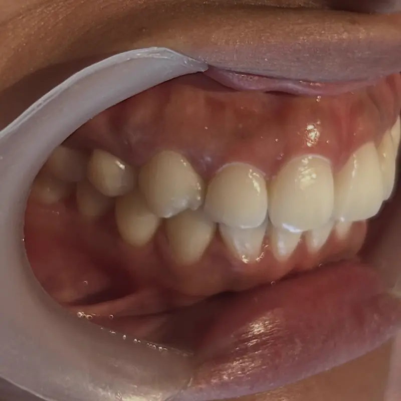 Antes: cierre de diastemas con resina en NK Art Estudio Dental Querétaro