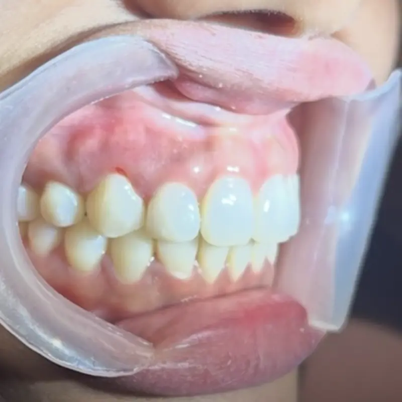 Después: cierre de diastemas con resina en NK Art Estudio Dental Querétaro