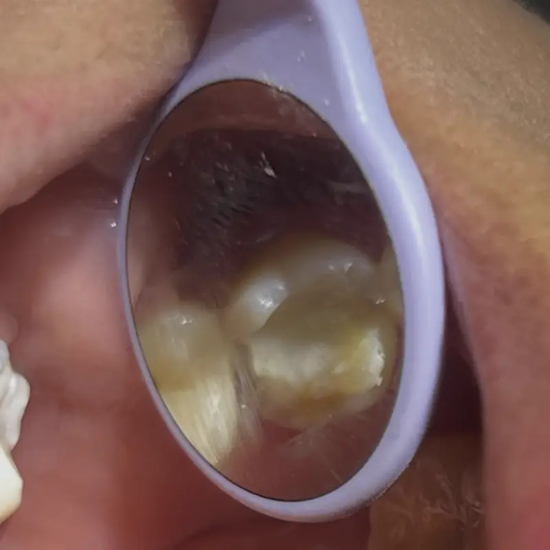 Antes de una incrustación de zirconia realizada en NK Art