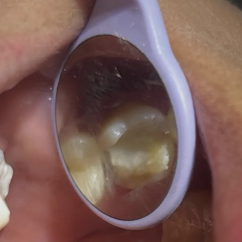 Antes: incrustación de zirconia en NK Art Estudio Dental Querétaro