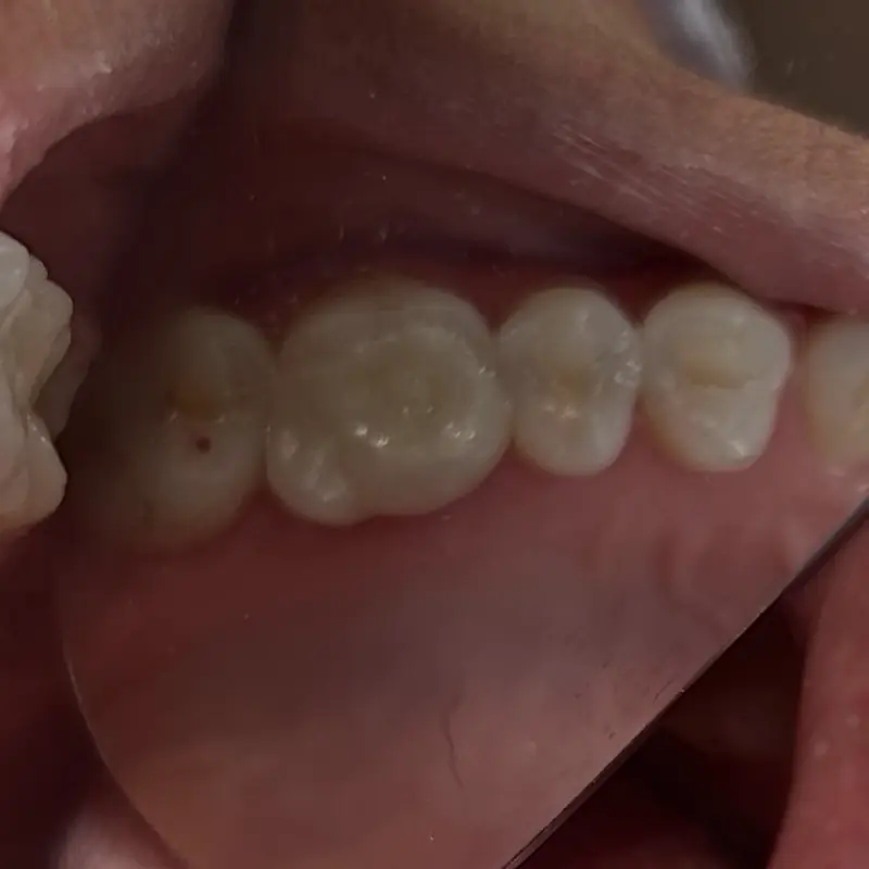 Después de una incrustación de zirconia realizada en NK Art