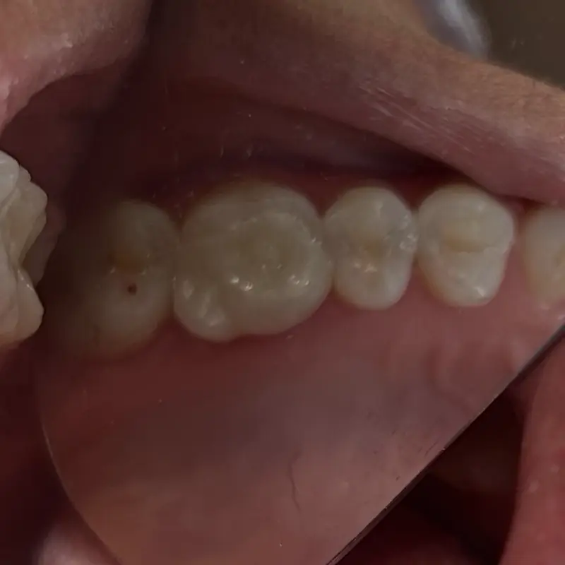 Después: incrustación de zirconia en NK Art Estudio Dental Querétaro