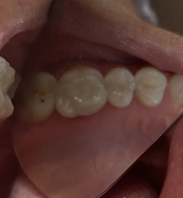 Después de la incrustación de zirconia