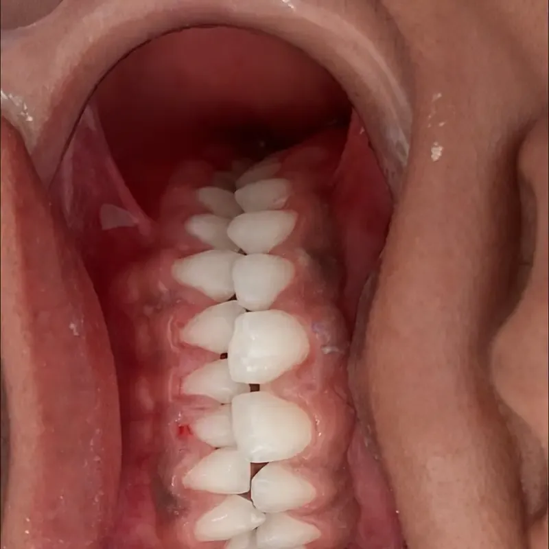 Después de una limpieza y aclaramiento dental en NK Art