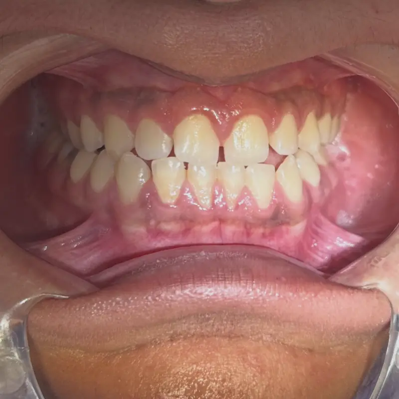 Antes: limpieza y aclaramiento en NK Art Estudio Dental Querétaro