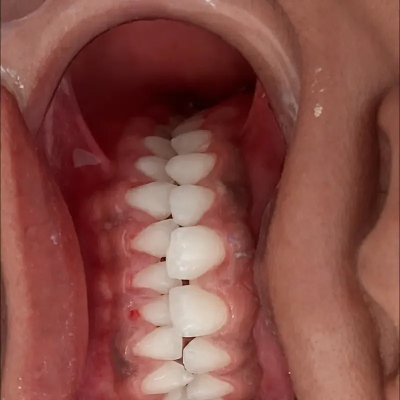 Después: limpieza y aclaramiento en NK Art Estudio Dental Querétaro