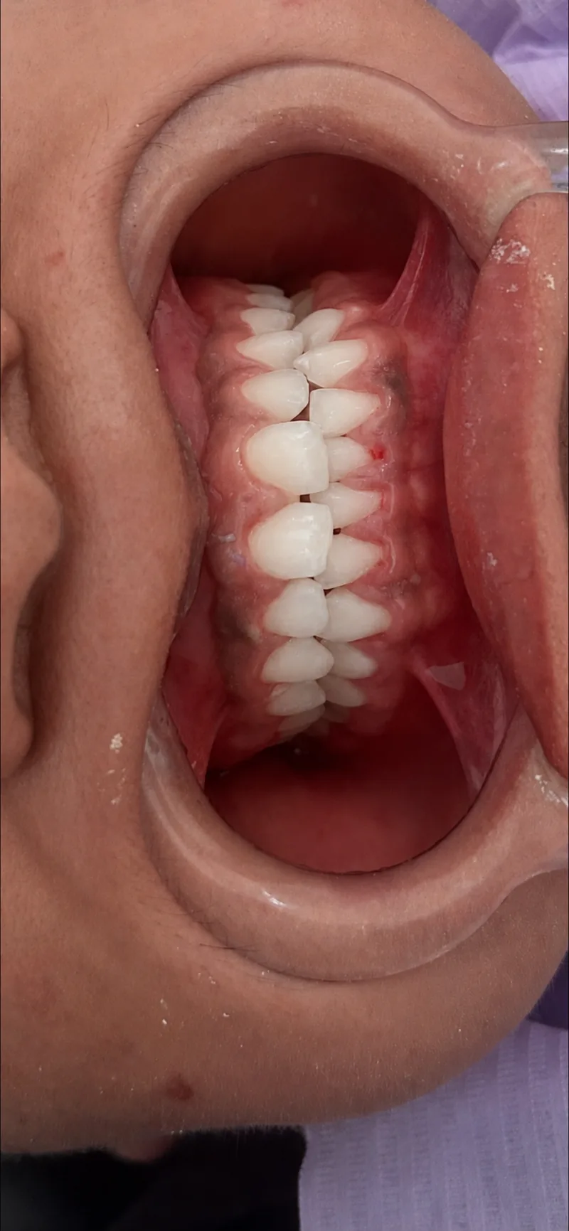Después: limpieza y aclaramiento en NK Art Estudio Dental Querétaro