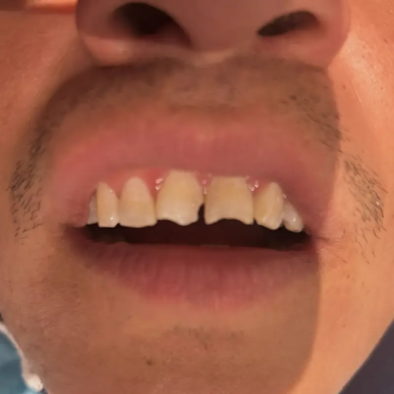 Antes: fractura dental tratada con resina en NK Art Estudio Dental Querétaro