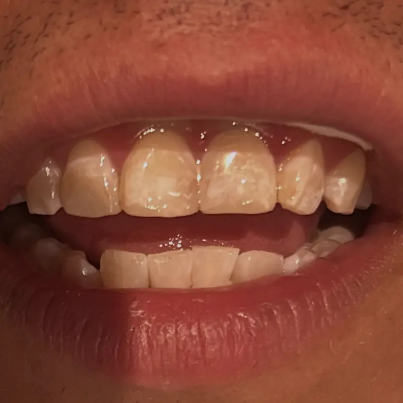 Después de reparar una fractura dental con resina en NK Art