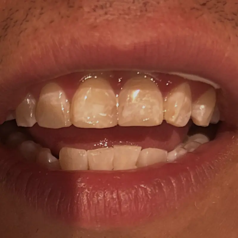 Después: reconstrucción de fractura con resina en NK Art Estudio Dental Querétaro