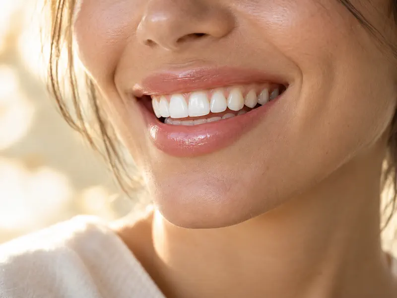 Sonrisa después de un blanqueamiento dental supervisado en Querétaro